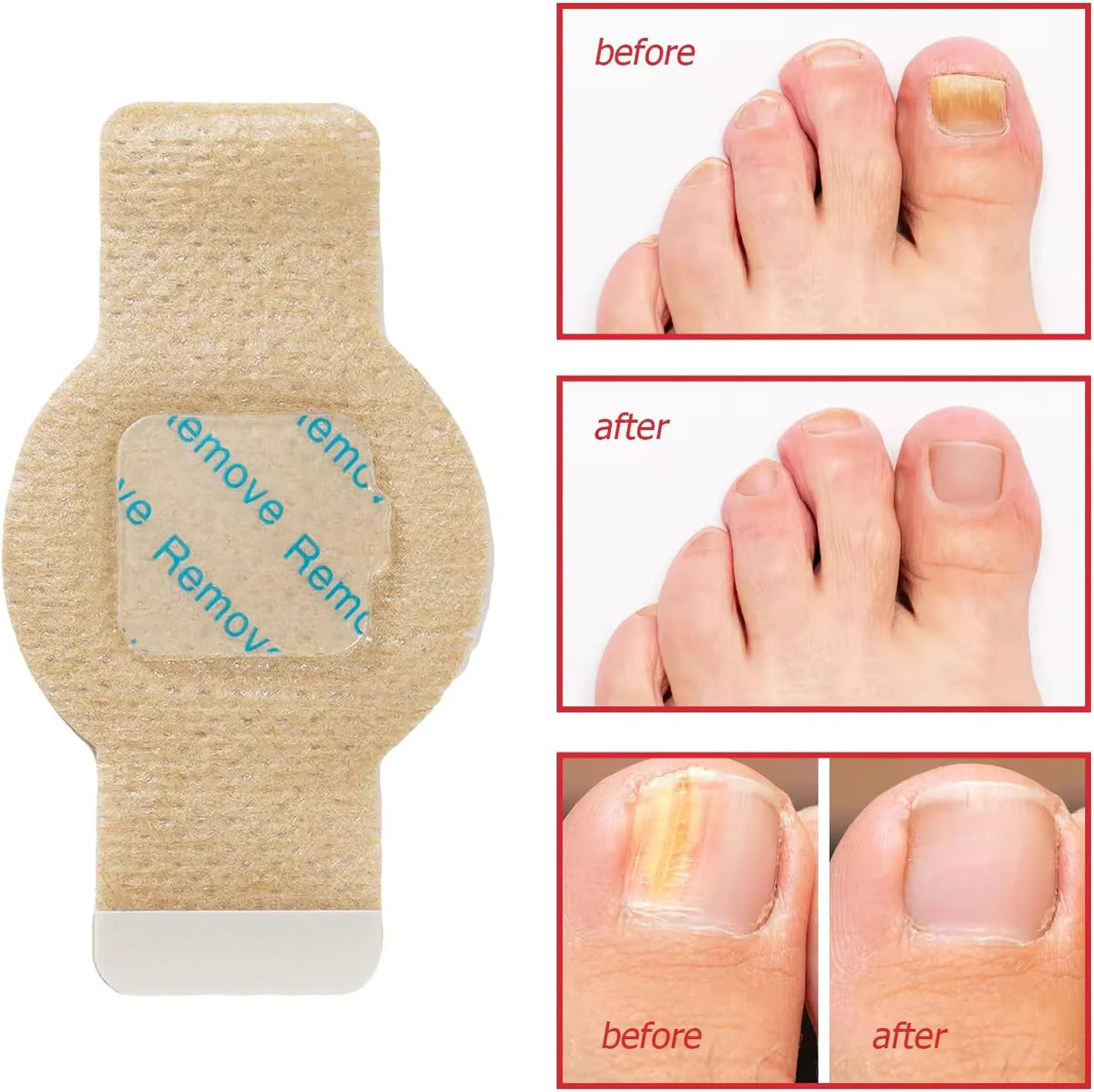 Nighttime Renewal Fungal Nail Treatment Patches